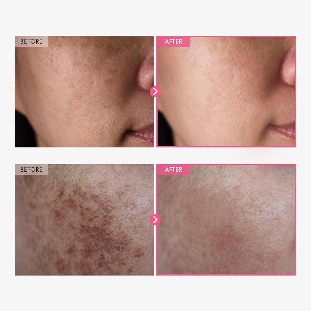 Arbutin 7% + Tranexamic Acid 4% Cream 50ml
