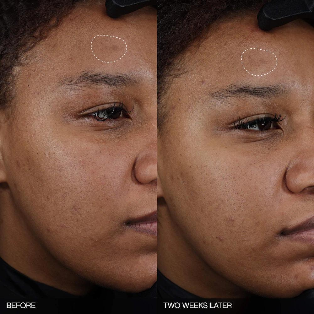 Faded Tranexamic Acid Dark Spot Patches for Hyperpigmentation