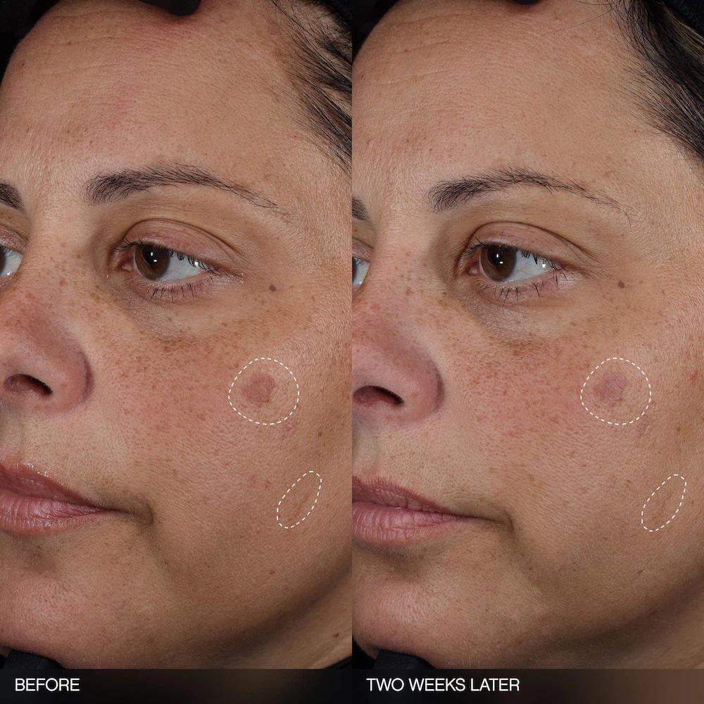 Faded Tranexamic Acid Dark Spot Patches for Hyperpigmentation