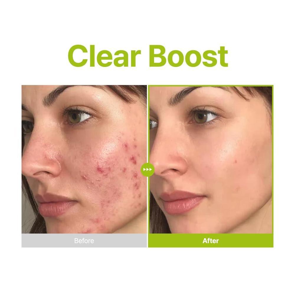 Azelaic Acid 10% Facial Serum 30 ml