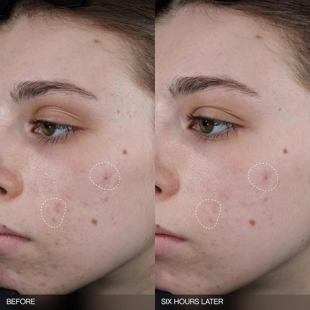 Faded Tranexamic Acid Dark Spot Patches for Hyperpigmentation