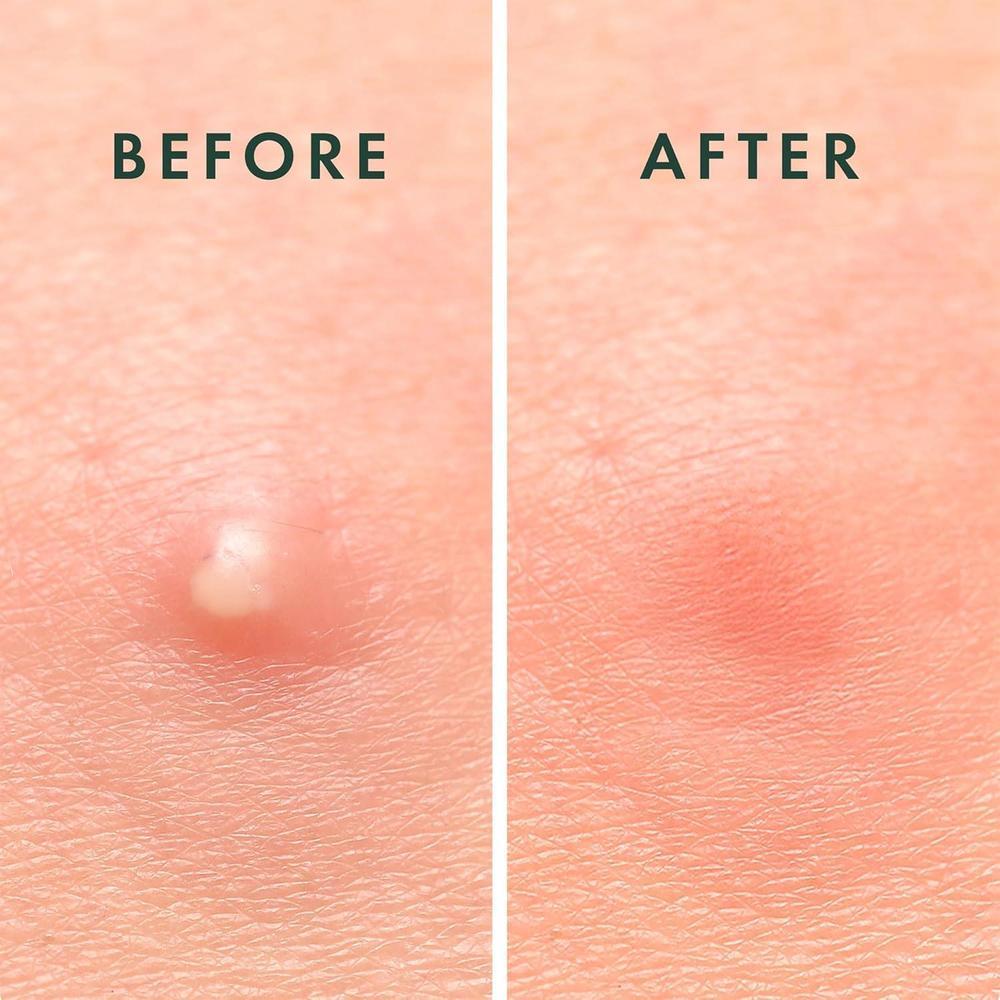 Rael Invisible Spot Cover Hydrocolloid Pimple Patch 96UM